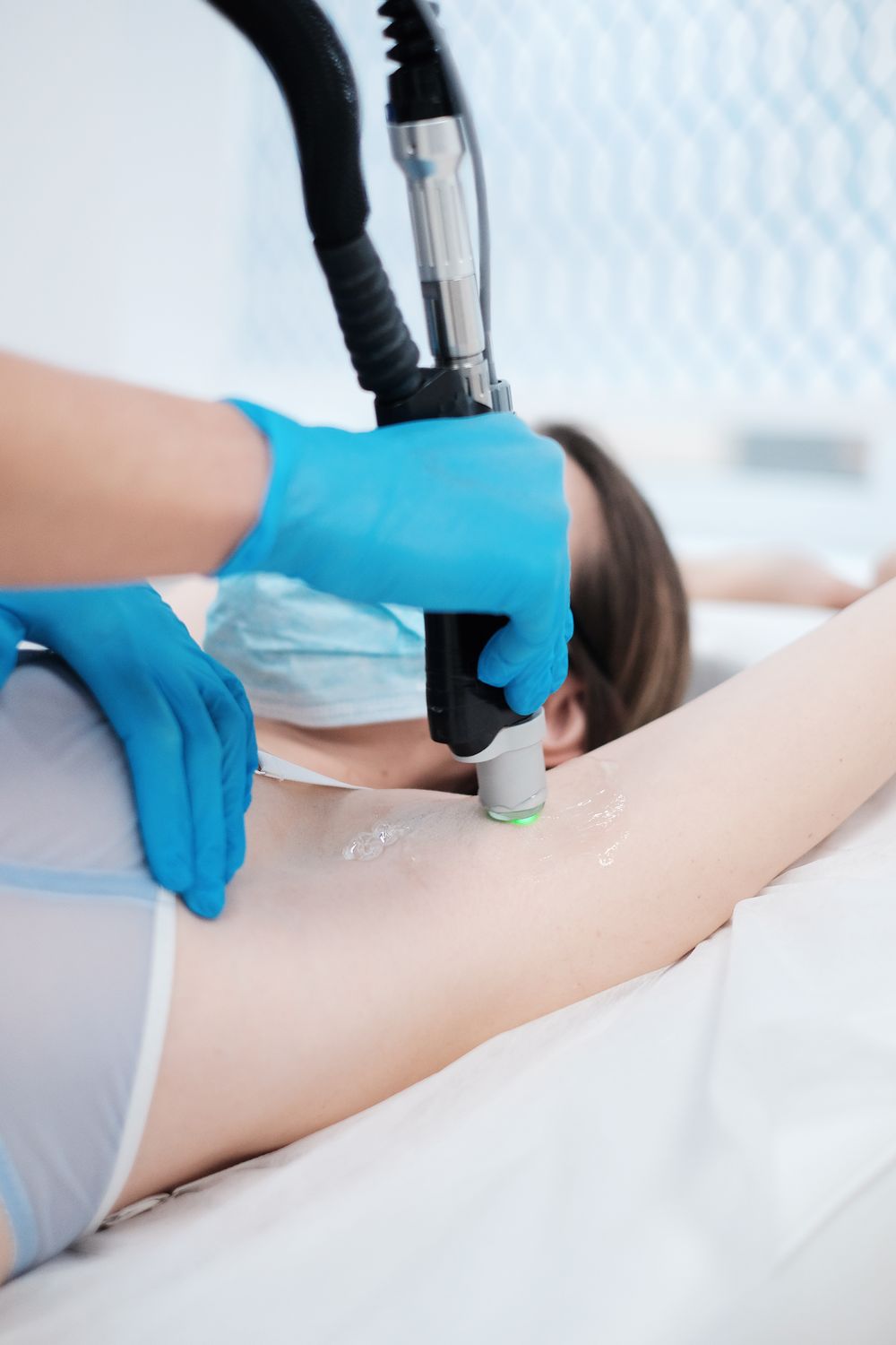 Лазерная эпиляция